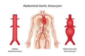 Read more about the article Abdominal Aortic Aneurysm Causes, Symptoms, and Treatment