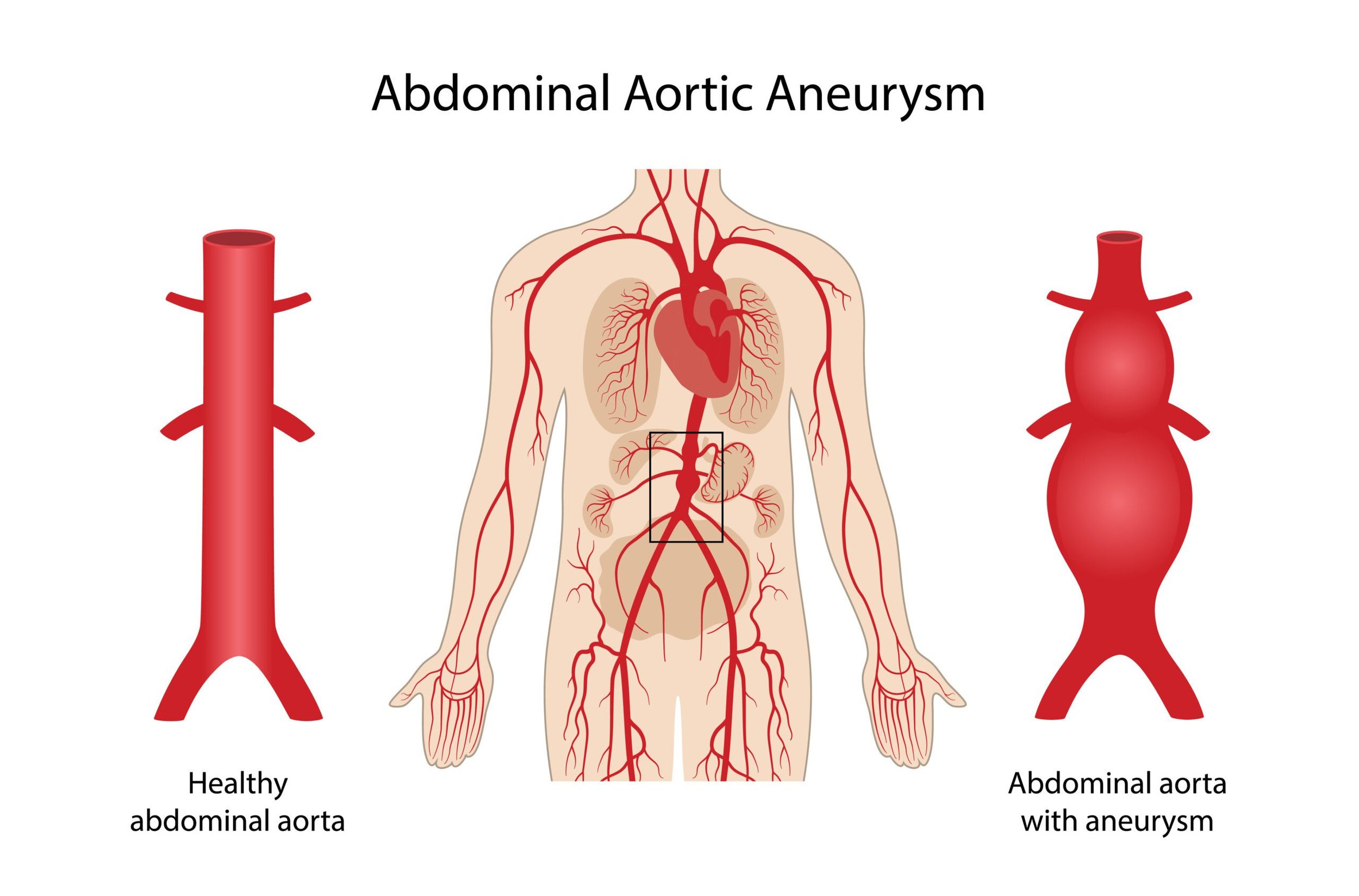 You are currently viewing Abdominal Aortic Aneurysm Causes, Symptoms, and Treatment