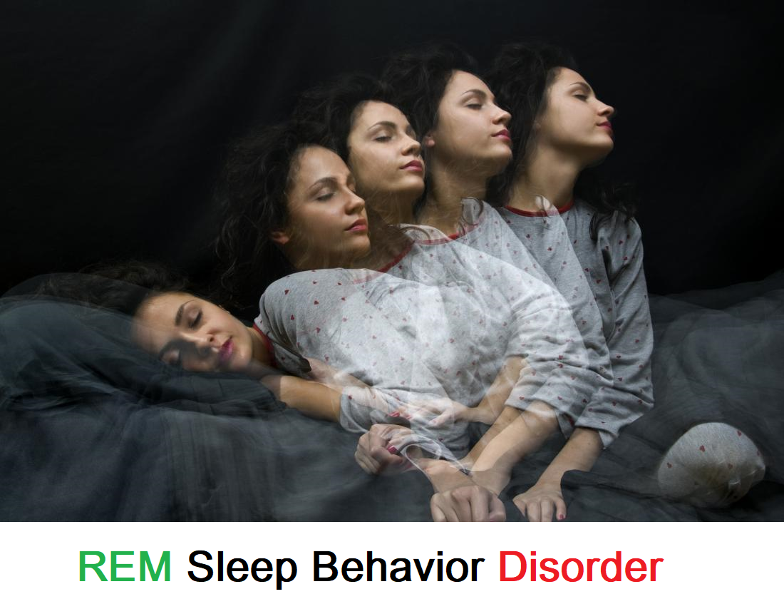 Read more about the article REM Sleep Behavior Disorder – Updated 2024