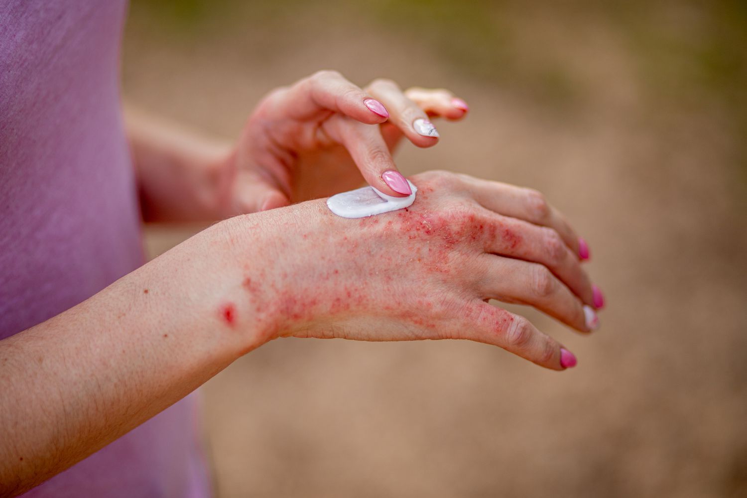 Read more about the article Eczema Latest Research
