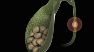 Read more about the article Gallstones: Causes, Symptoms, and Treatment